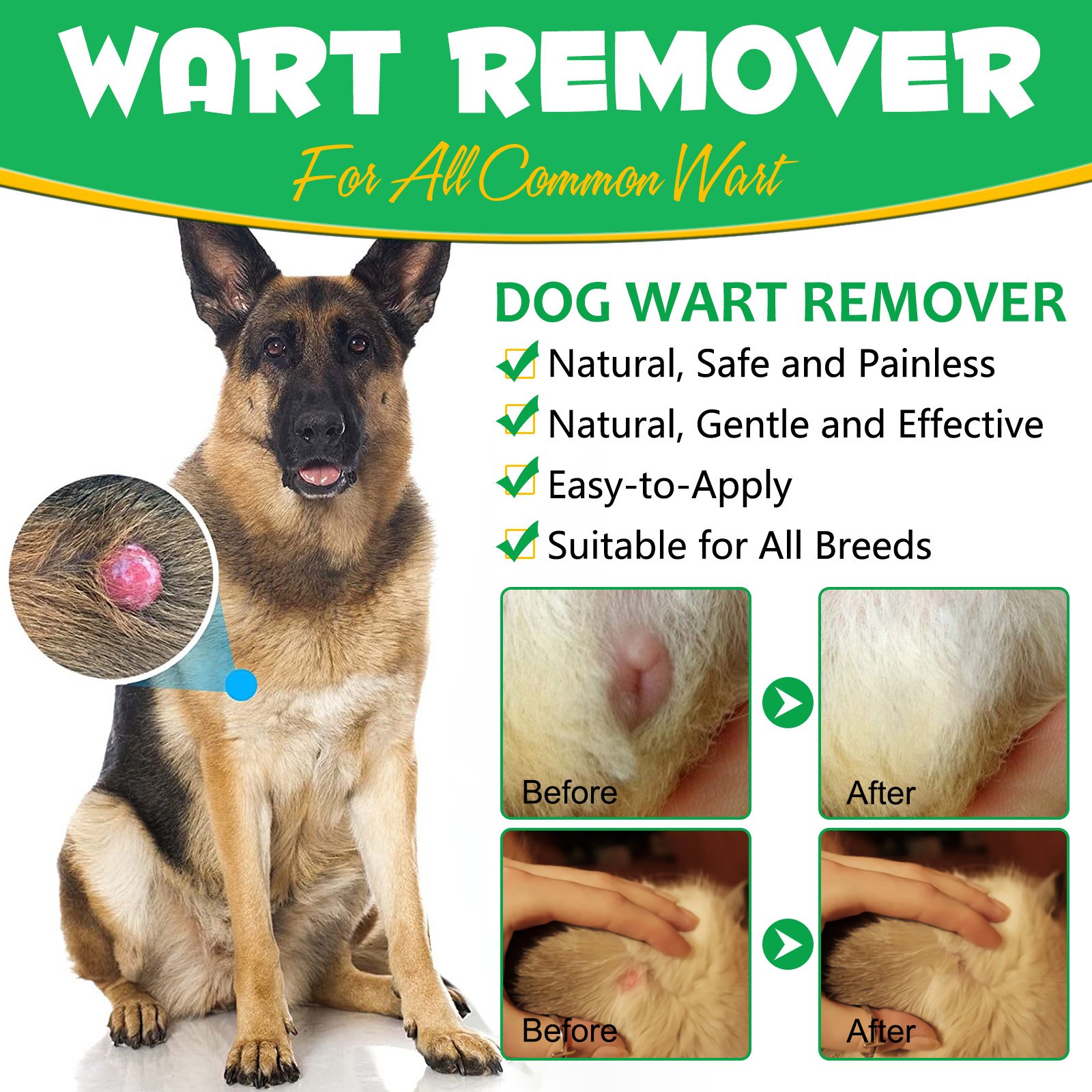 Wart Remover